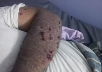 إصابة مزارع وإعطاب حراثته بانفجار لغم حوثي في حيس بالحديدة