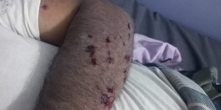 إصابة مزارع وإعطاب حراثته بانفجار لغم حوثي في حيس بالحديدة